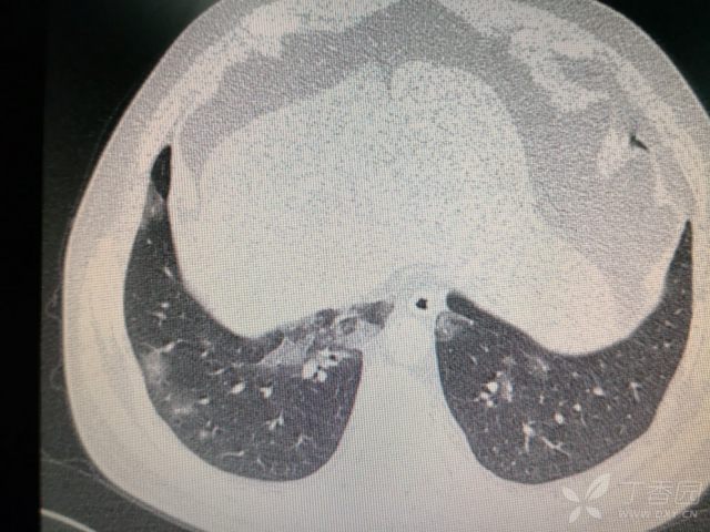 两肺阴影,间质性肺炎? [病例帖]