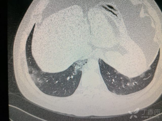 两肺阴影,间质性肺炎? [病例帖]