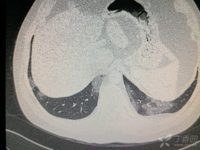 两肺阴影,间质性肺炎? [病例帖]