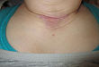 病例挑战：突发颈部硬结