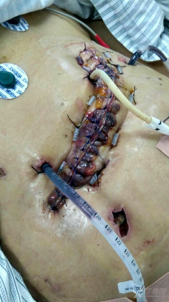宫外孕手术后伤口图片图片