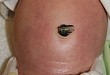 新病报道：新生儿脐周自限性红斑