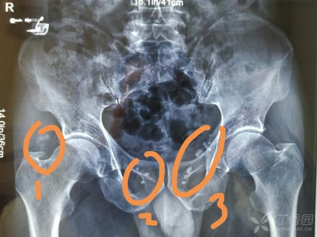 骨盆请老师看一下,右侧股骨是软骨瘤?盆腔内静脉石!