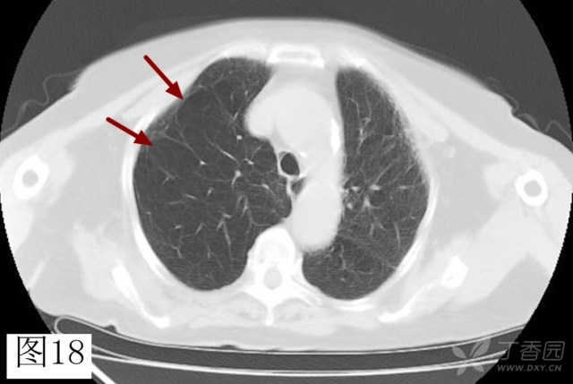 读书笔记:肺气肿的 4 个 ct 表现