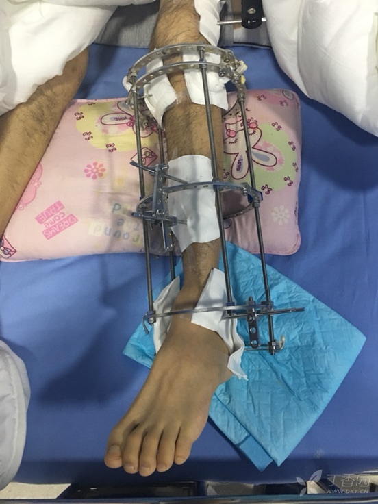 胫腓骨远端开放性骨折行骨搬运术后,求下步治疗方案.