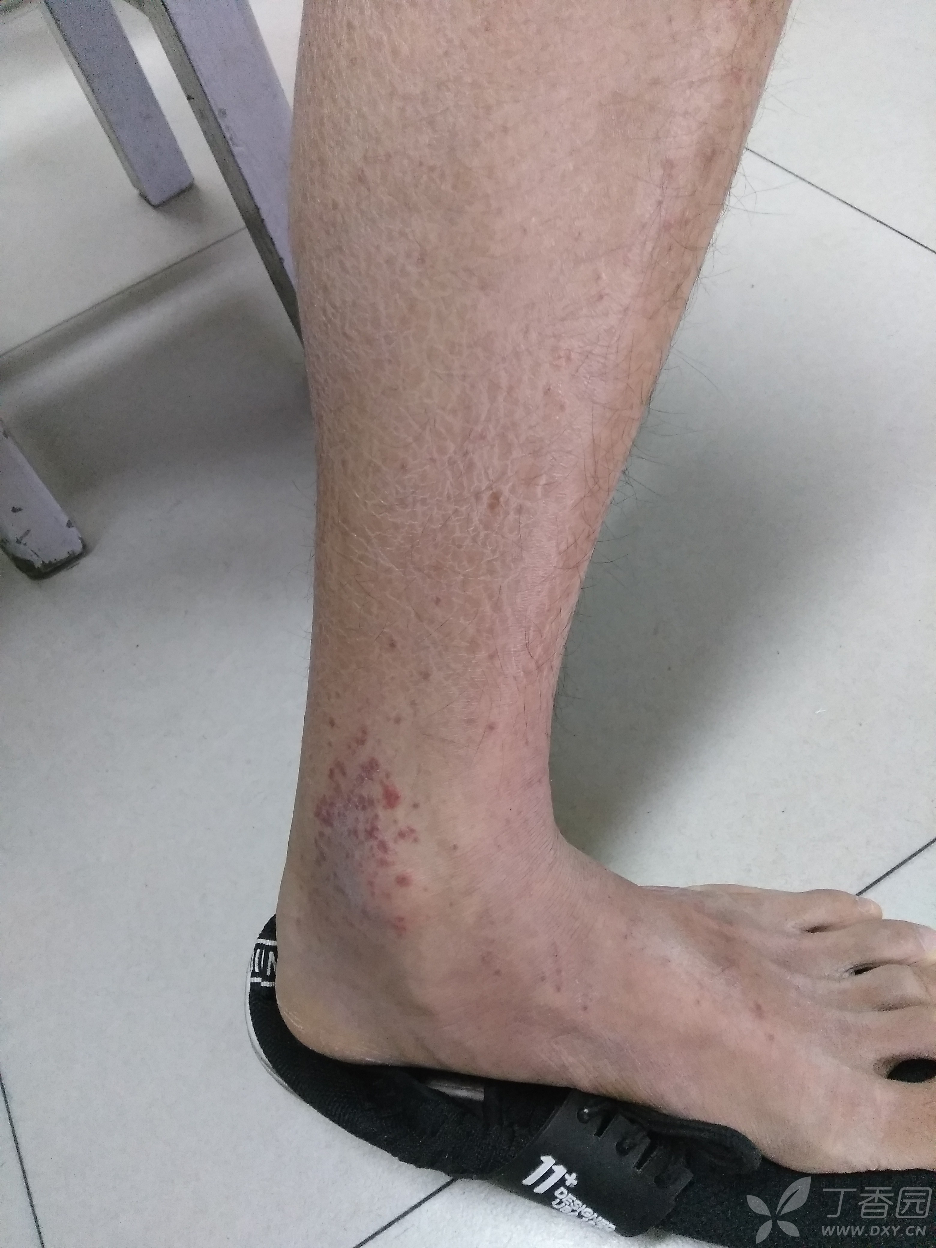 男,17岁,左小腿,足部皮肤红斑,痒,疼痛求诊断及治疗