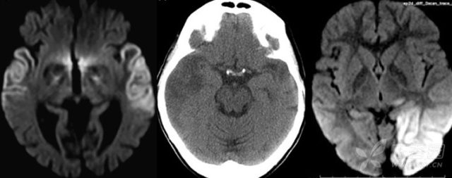 右侧额叶皮层异常信号 这 3 个部位的皮层异常信号，你会如何诊断？