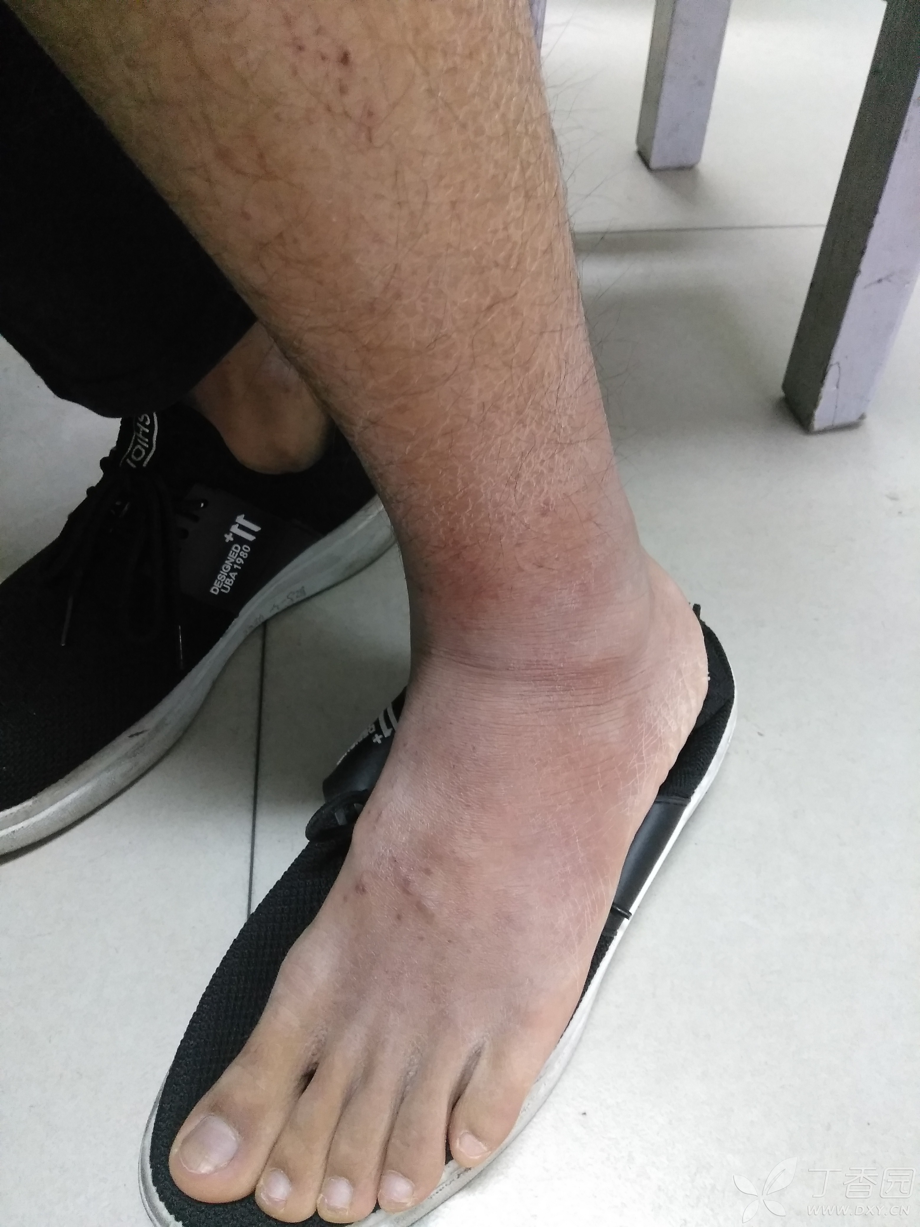 男,17岁,左小腿,足部皮肤红斑,痒,疼痛.求诊断及治疗.