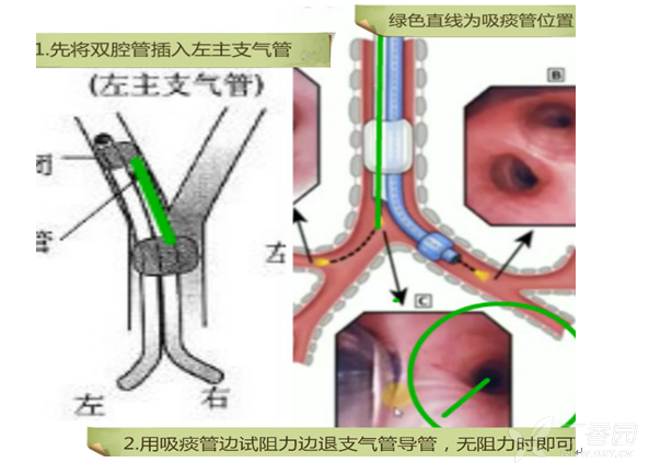 双腔气管导管图解图片