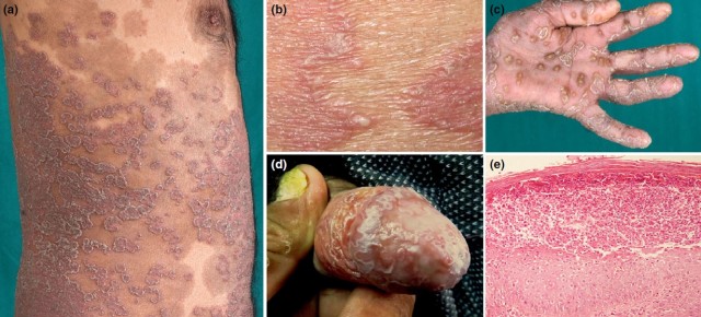 呈旋渦狀外觀(圖 1a,b),手掌為典型的膿溢性皮膚角化病(keratoderma