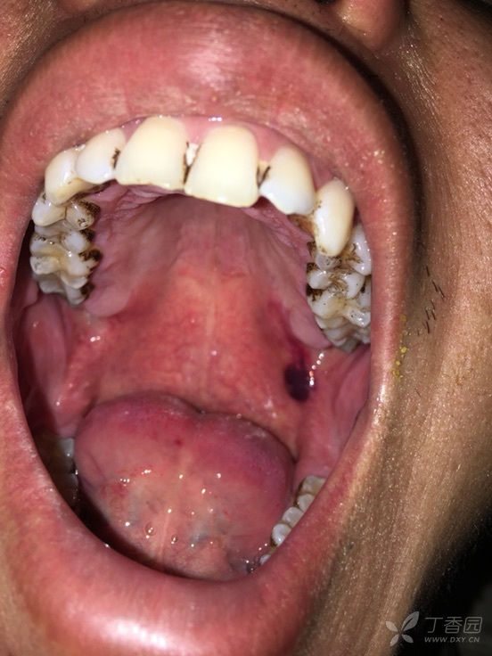 口腔内壁血泡图片