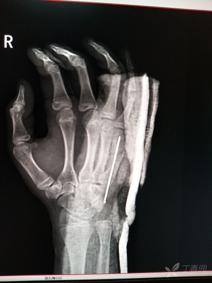 由于暴力拳击所致 第五掌骨骨折 4天前手术后为什么无名指也有些疼 很难弯曲全 按片子我多久可以不用第五掌骨骨折需要多久