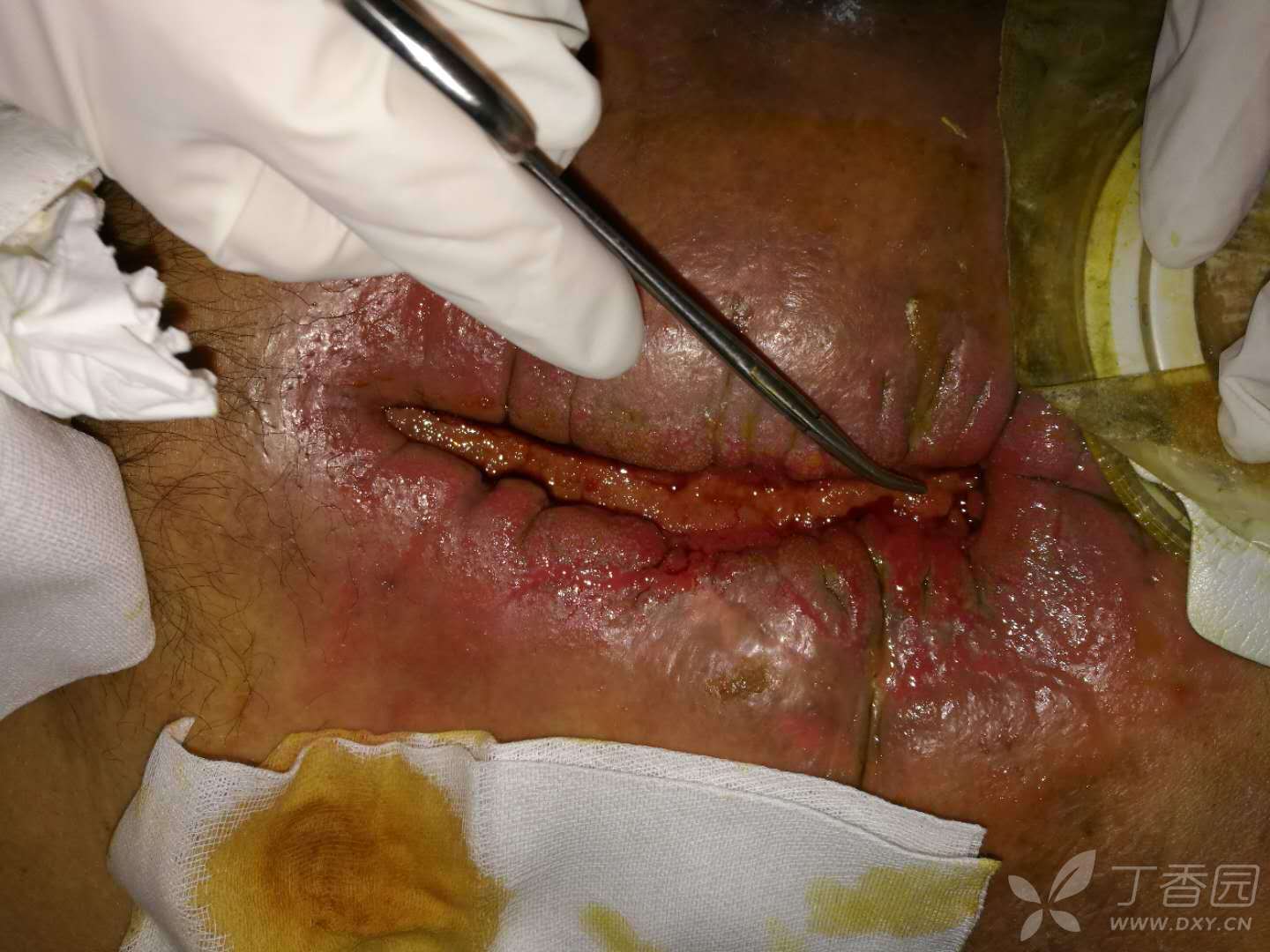 直肠癌造瘘口恢复图片图片