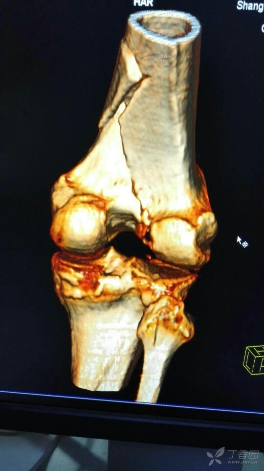 股骨下段骨折一例,求各位大神指教 [病例帖]