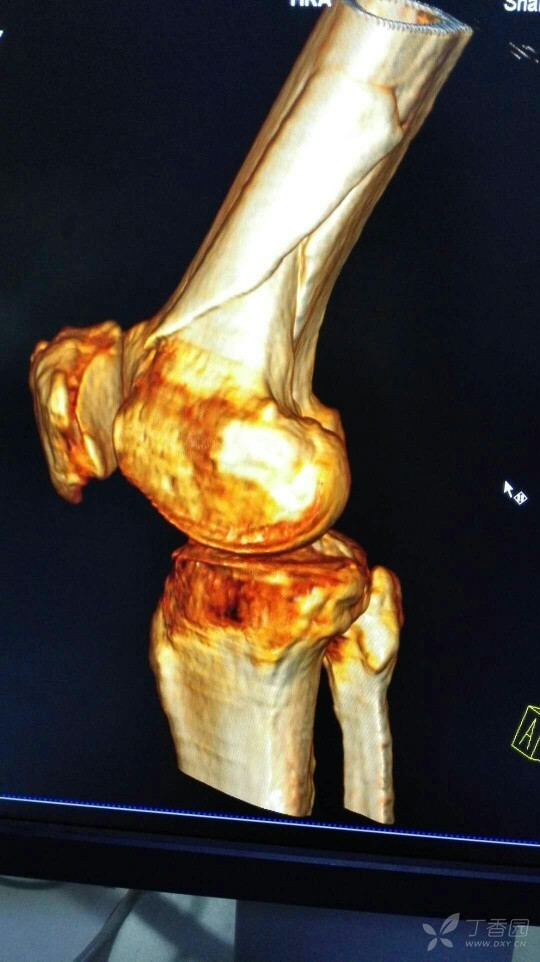 股骨下段骨折一例,求各位大神指教 [病例帖]