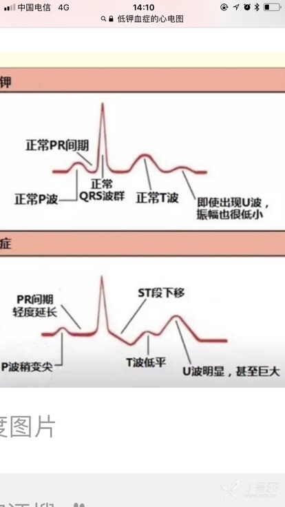 低钾血症时,qt段延长,pr段延长,怎么心率还能增快呢?