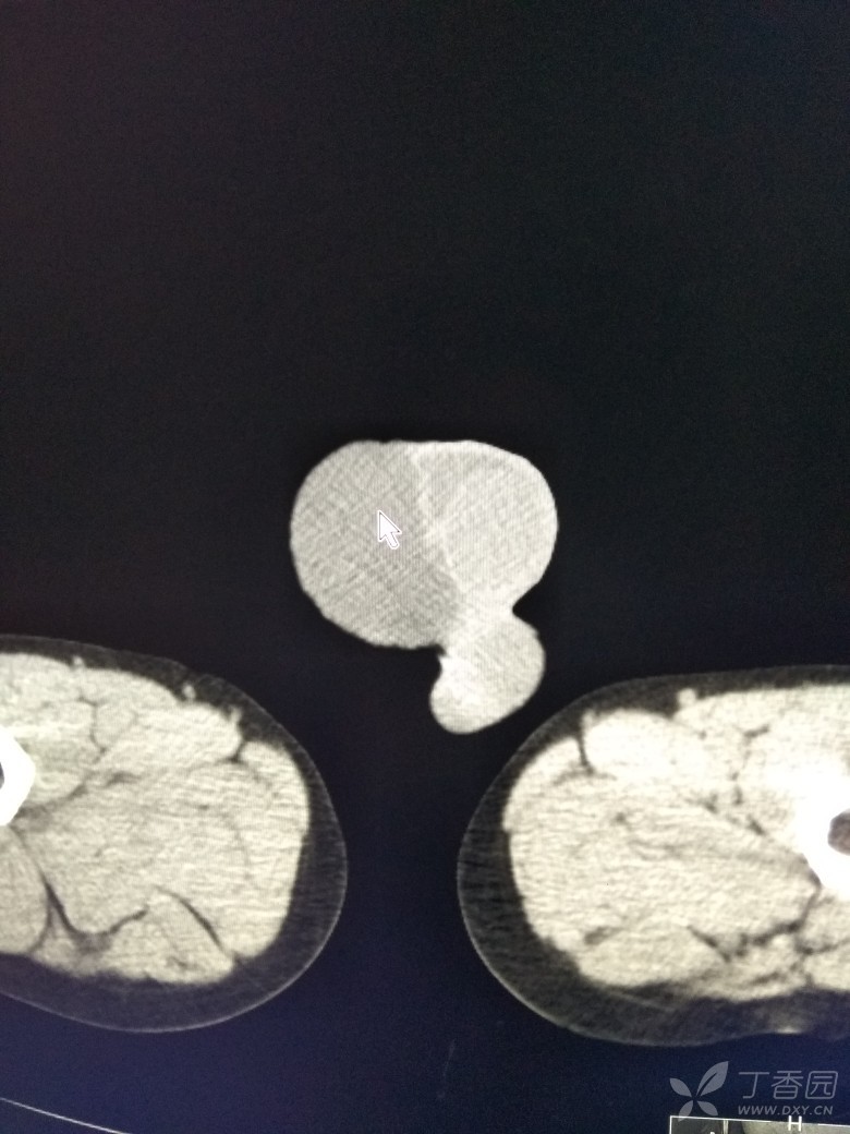 相关疾病: 腹股沟斜疝 鞘膜积液             
