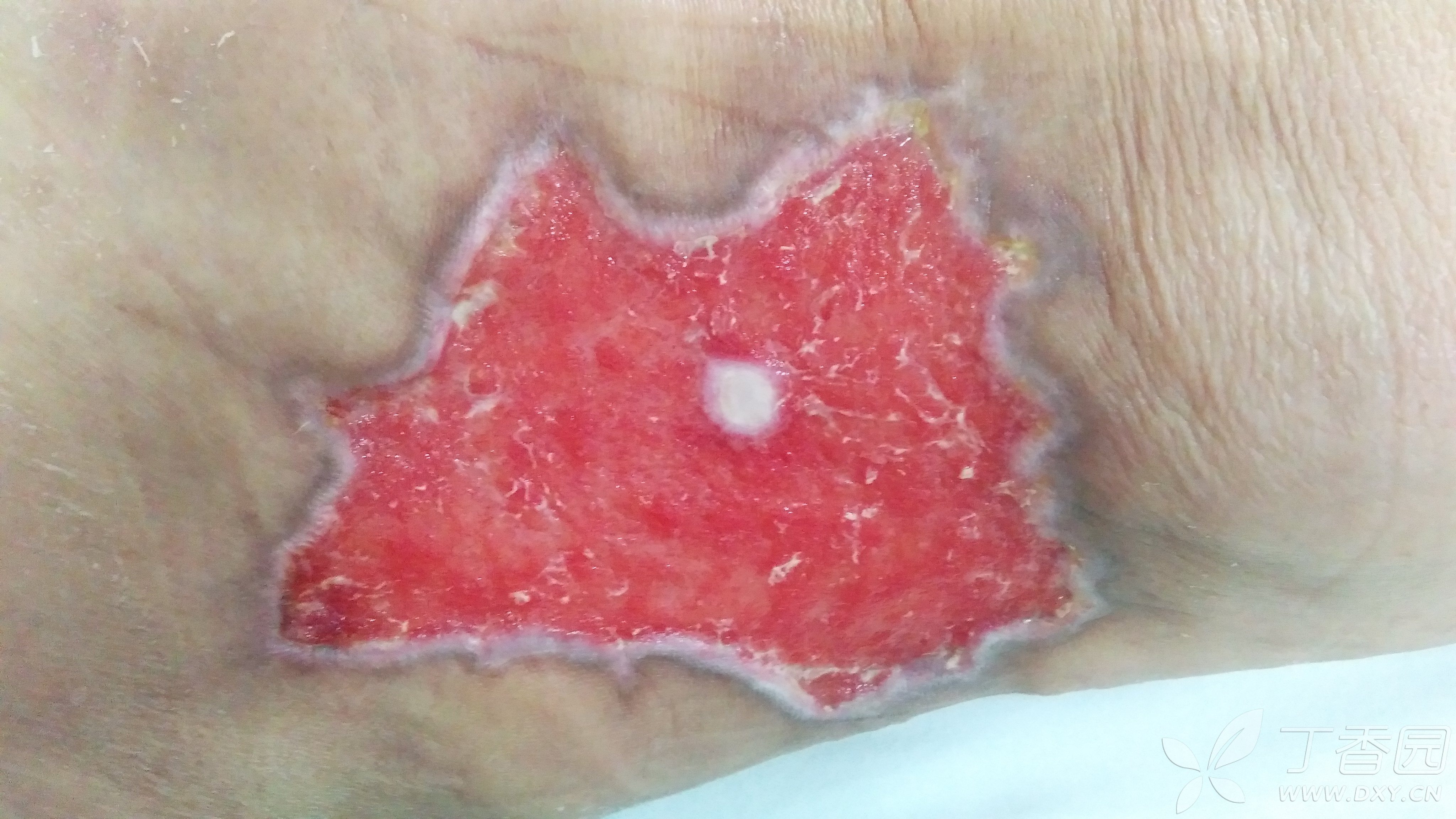 大面积皮肤缺损,换药2月愈合 [病例帖]