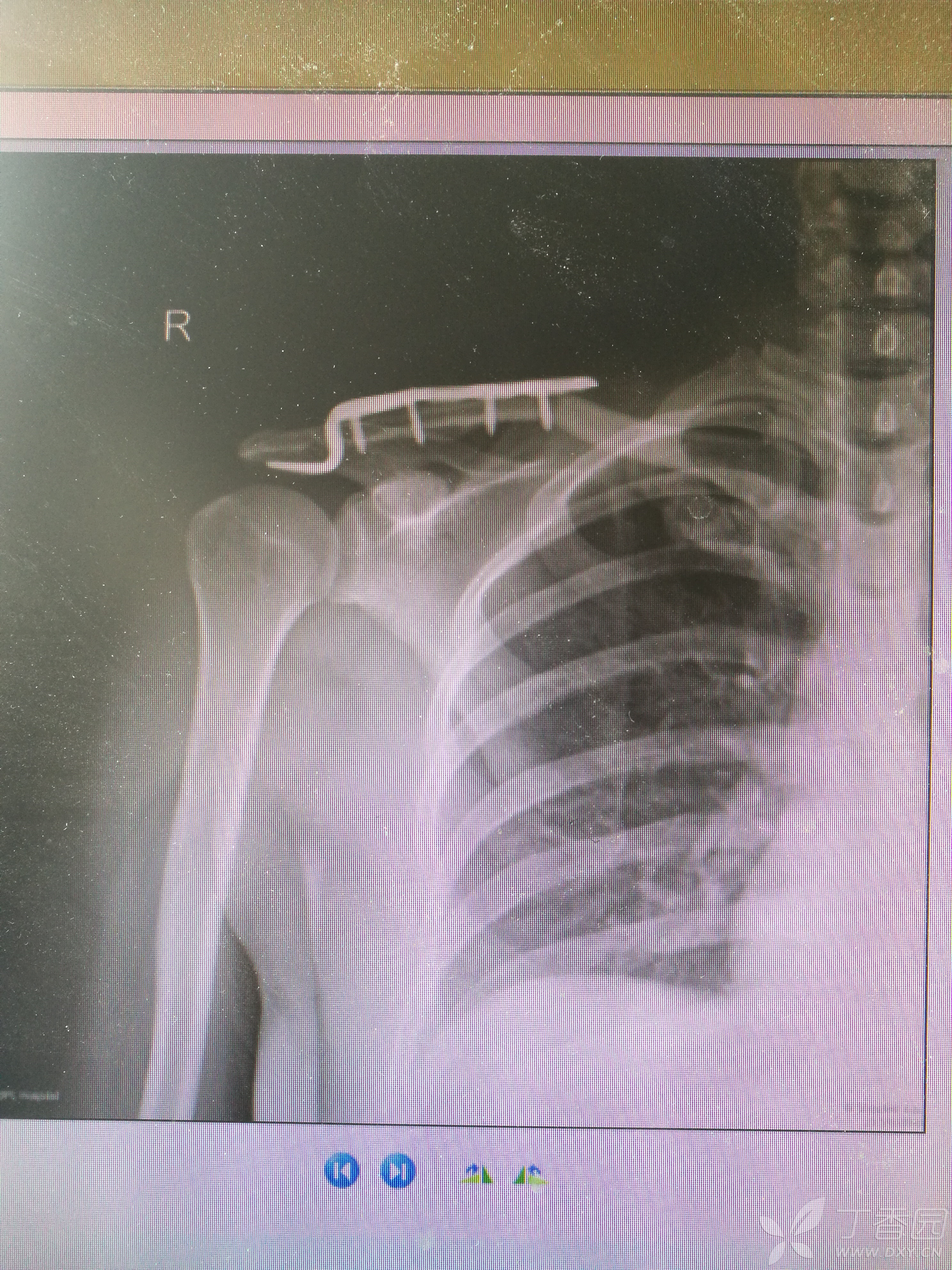 肩锁关节脱位术后锁骨骨折 [病例帖]