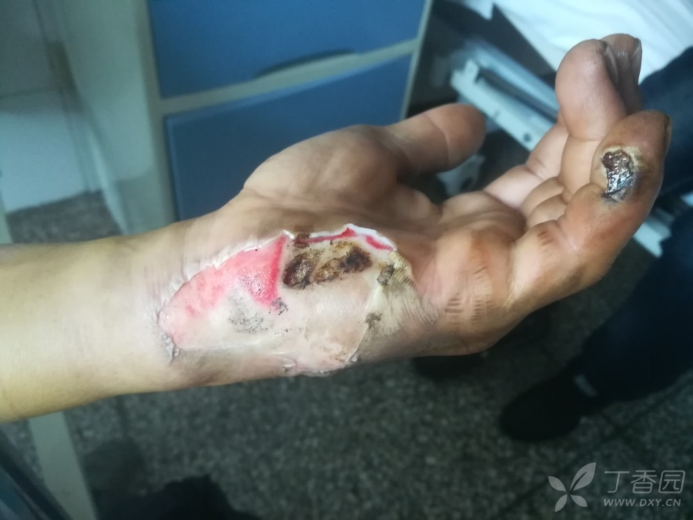 手电击伤 - 标签数据维护版块 -丁香园论坛