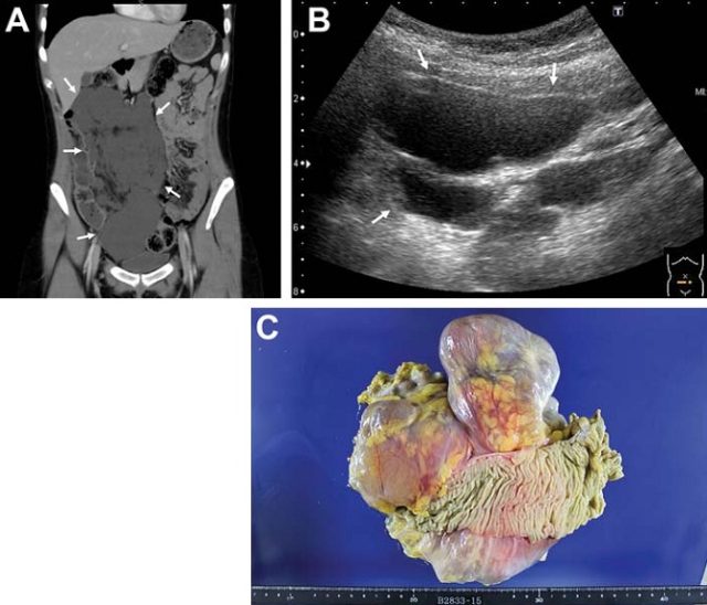 肠系膜淋巴管瘤 2 例成人肠系膜淋巴管瘤的超声体现