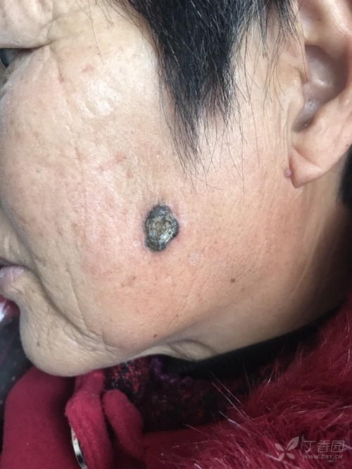 面部肿物怎么修复? [病例帖]