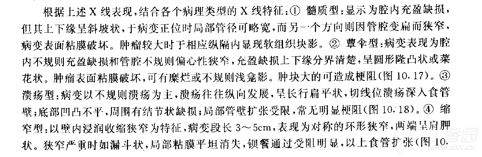 求教潰瘍型食管癌中的半月徵是什麼