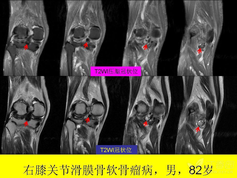 关节滑膜骨软骨瘤病的影像诊断.