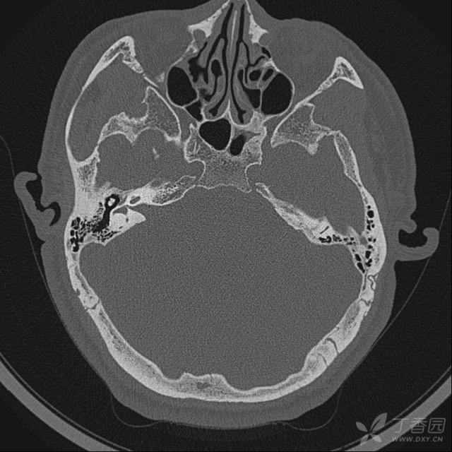 内听道喇叭口状扩大---听神经瘤.