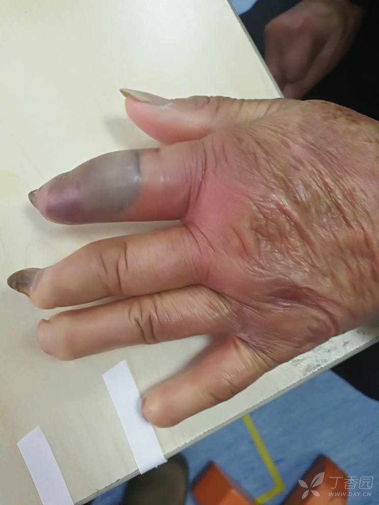 奇怪的手部感染. - 骨科专业讨论版 -丁香园论坛