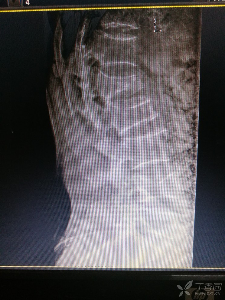 经腰椎ct及mr示腰椎1,4为新鲜骨折,l2为陈旧骨折
