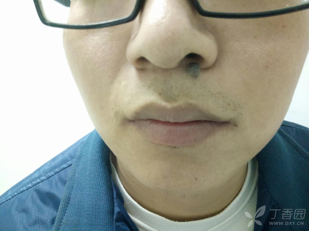 青年男性,色素痣,欲手术