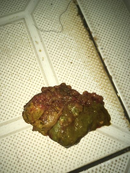 以下附检查报告及大便图片,各位讨论.