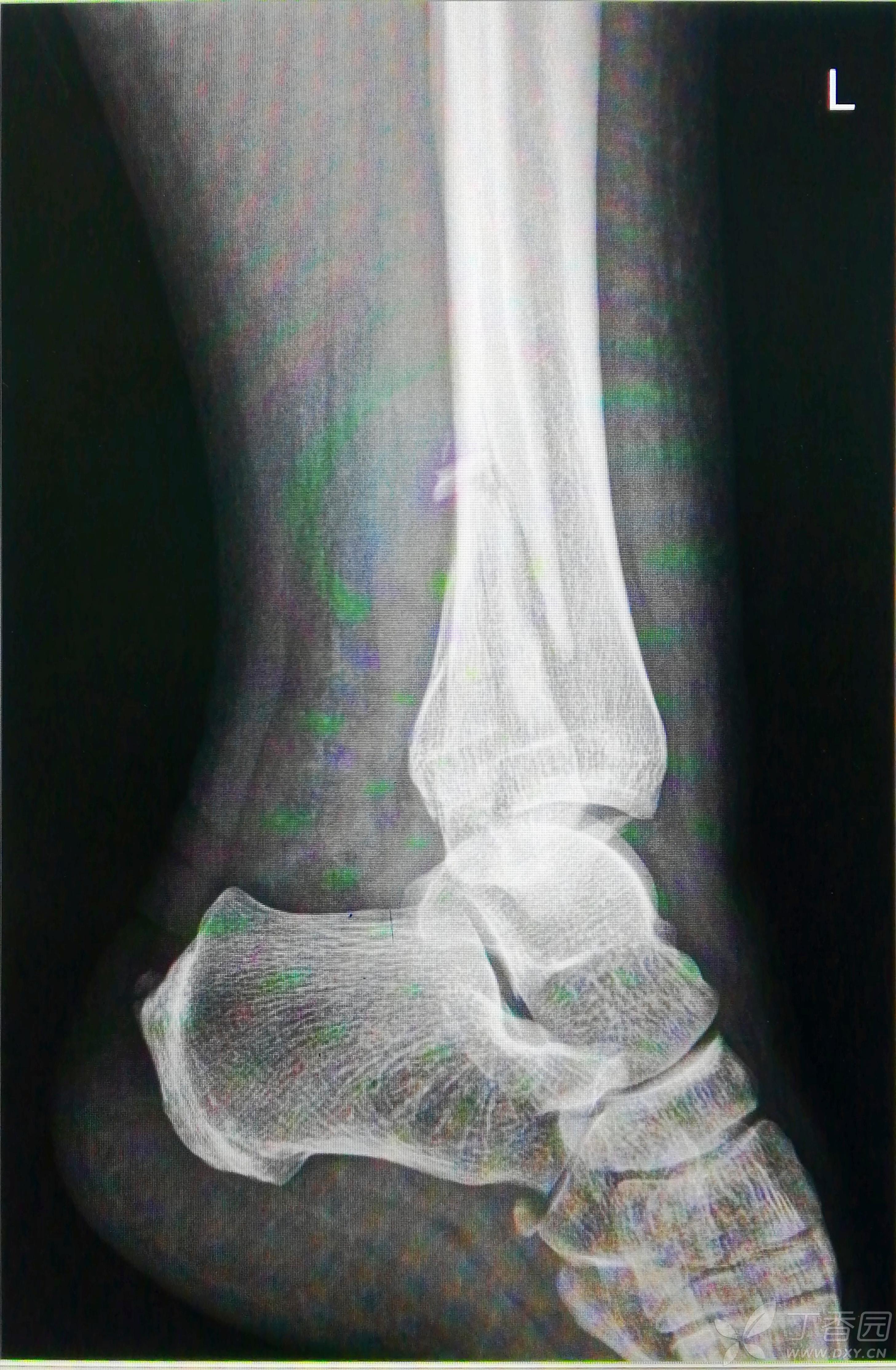 脚踝骨裂片子图片
