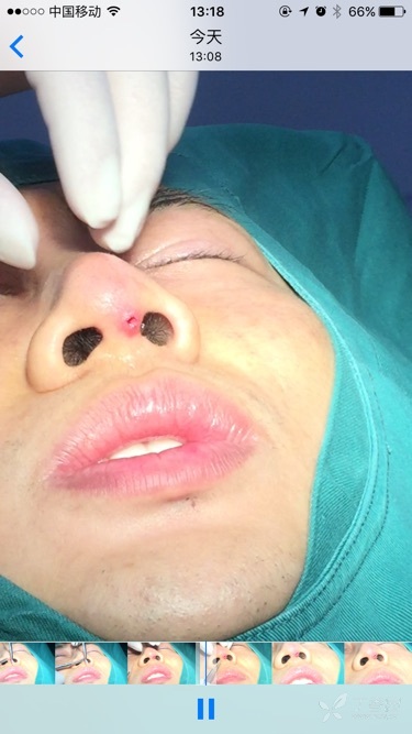 【讨论】单纯隆鼻鼻小柱处假体外漏.