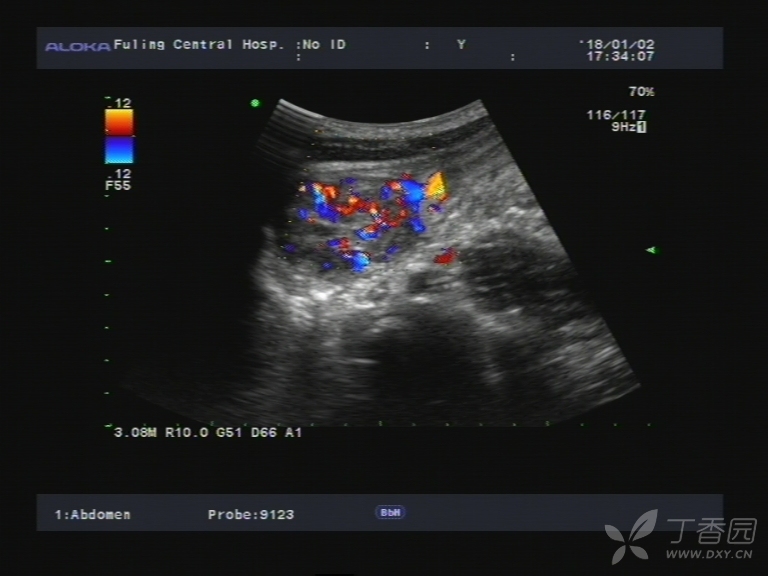 追踪血管是汇入肠系膜上动静脉的