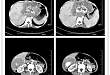 手术解析：复杂肝占位离体肝切除+自体肝移植术