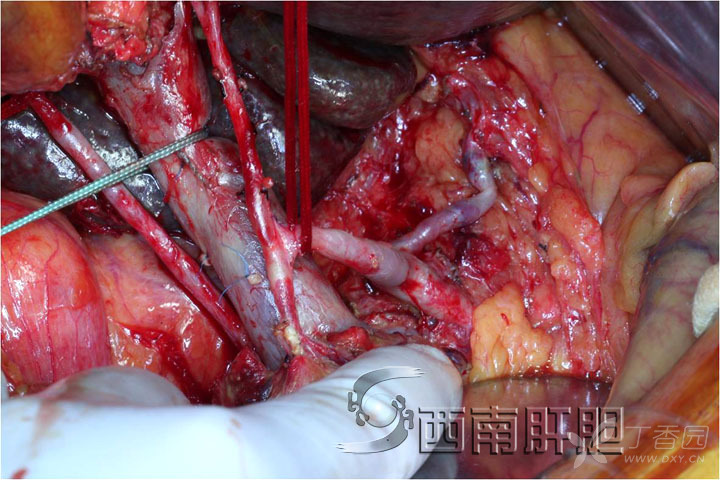 李大江肝門部膽管癌啞鈴型肝切除 2018-1-3