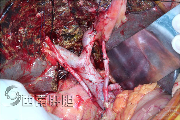 李大江肝门部胆管癌哑铃型肝切除 2018-1-3