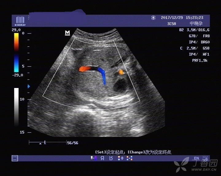 这是永久性右脐静脉吗?