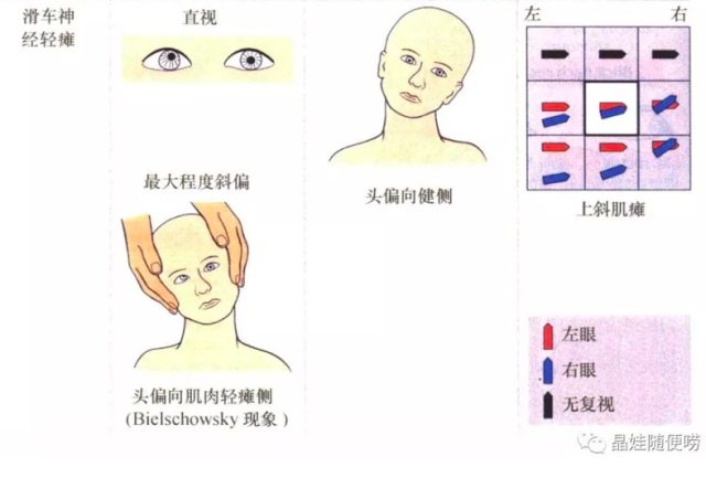 复视像图解图片