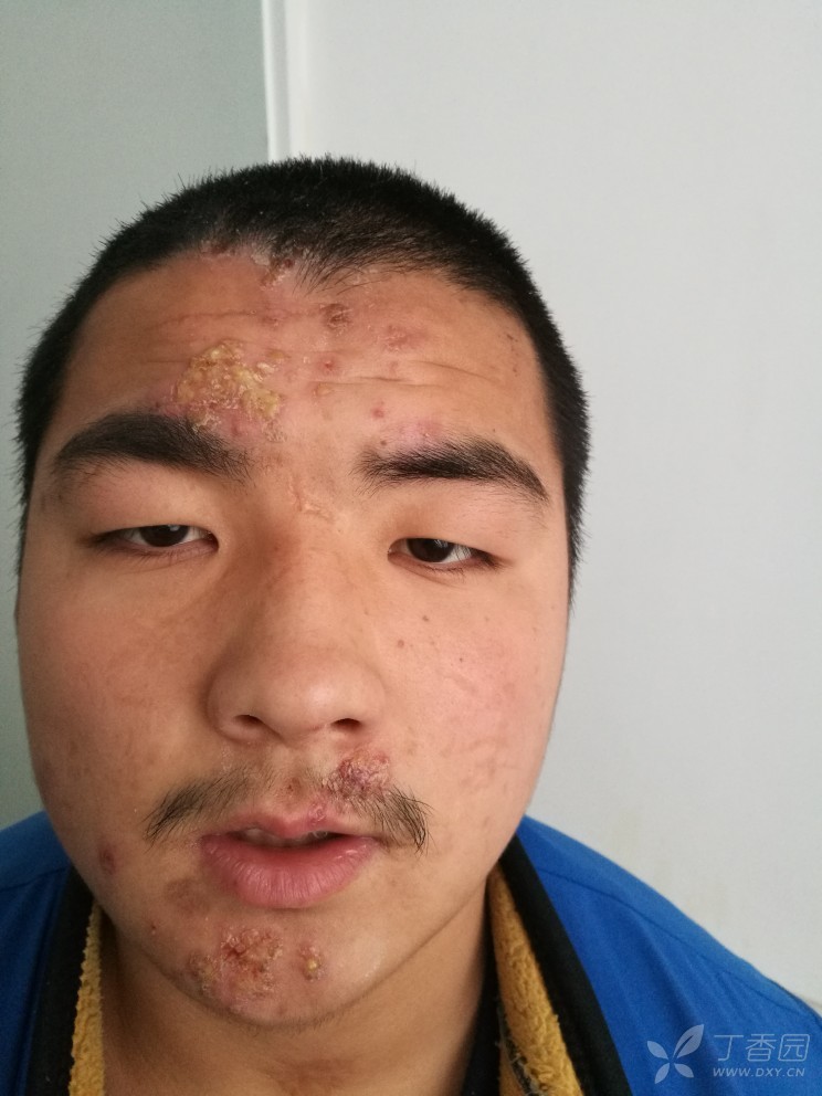 皮损初为水泡样,后化脓样改变,感痒痛,求会诊