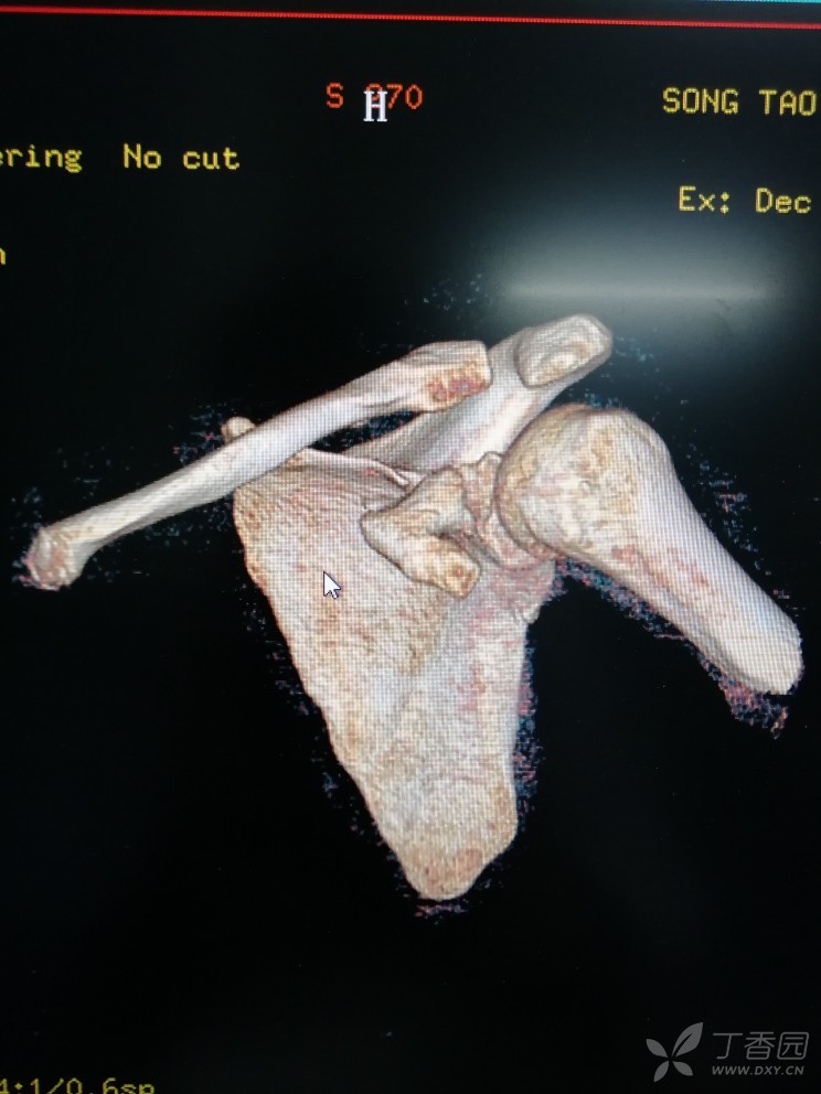 肩胛骨喙突骨折图片