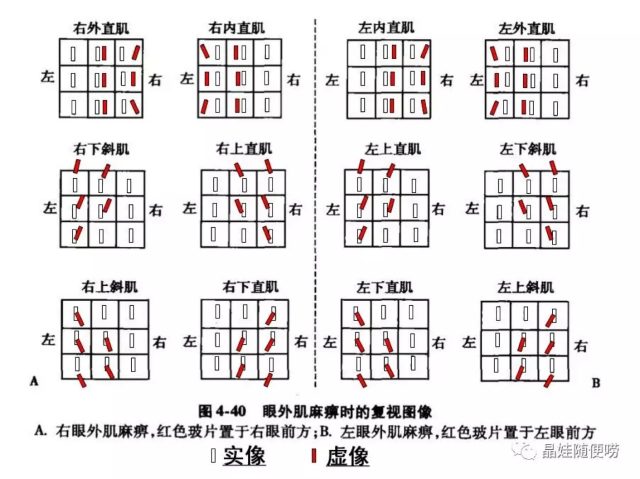 交叉复视图片