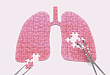 肺栓塞合并中重度血小板减少，如何进行抗栓治疗？