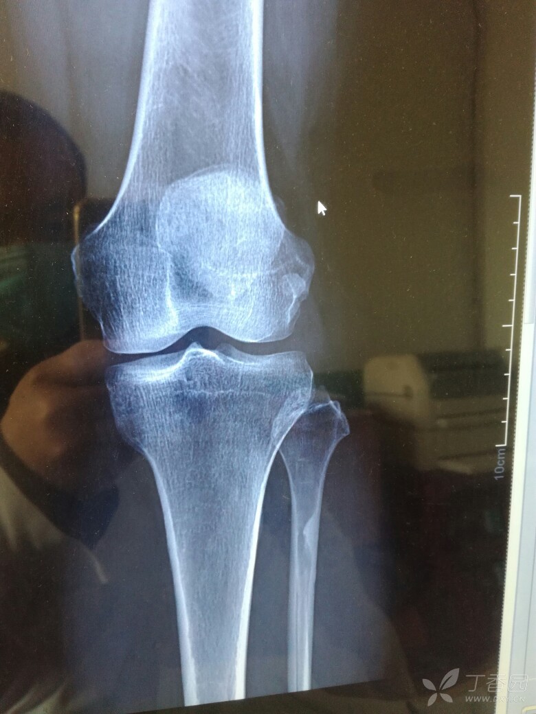 膝关节x光片正常图片