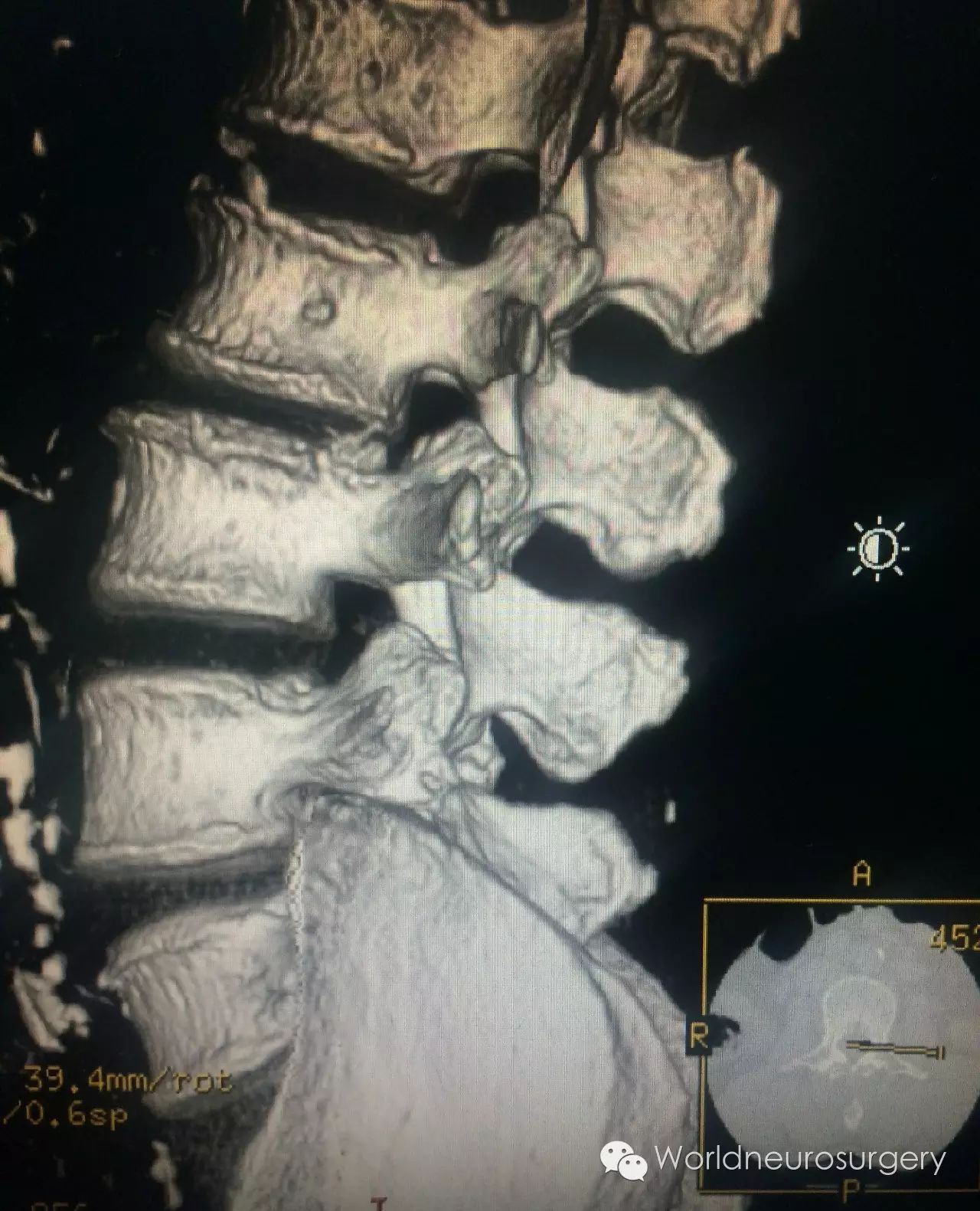 第2腰椎棘突图片