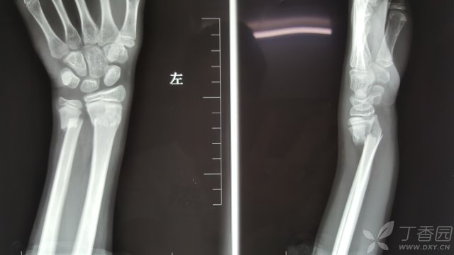 儿童尺桡骨双骨折保守治疗一例! [病例帖]