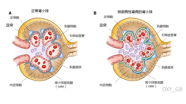 糖尿病吃什么菜最好 5图读懂糖尿病性肾病的发病、确诊与医治发展