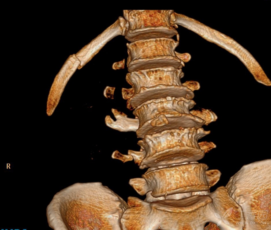 颈椎横突骨折图片